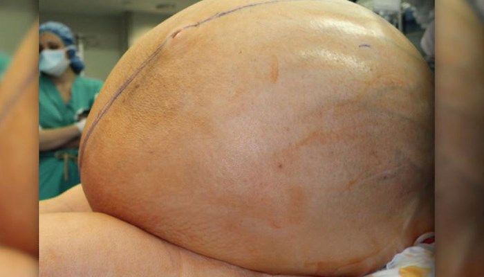 132-pound tumor removed from woman's abdomen